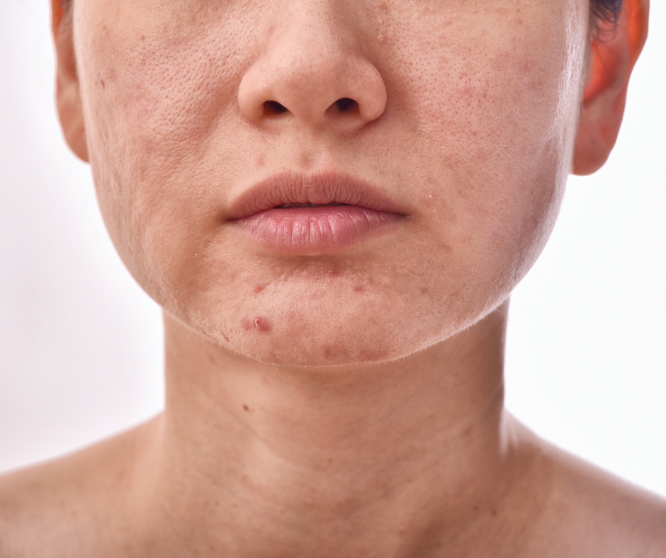 Huid met roodheid en onzuiverheden voor gebruik van Grassfed Glow whipped beef tallow balm